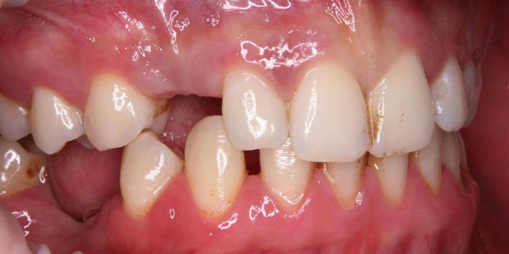  Восстановление утраченного зуба при помощи дентального импланта