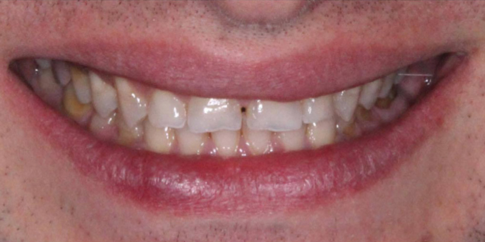  Реставрация стёртых зубов керамическими винирами