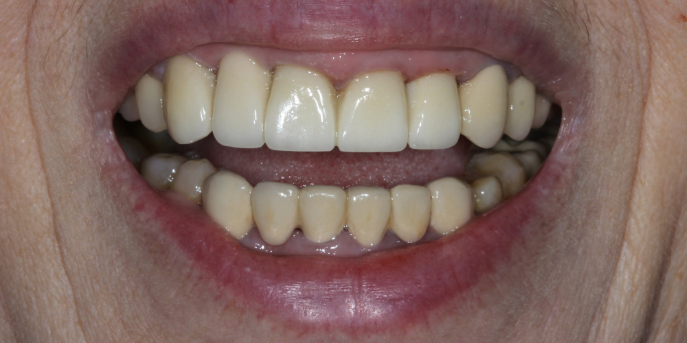  Протезирование 4х зубов и протезирование имплантата в области 12 зуба