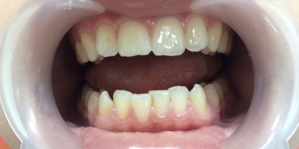  Исправление скрученности зубов на нижней челюсти