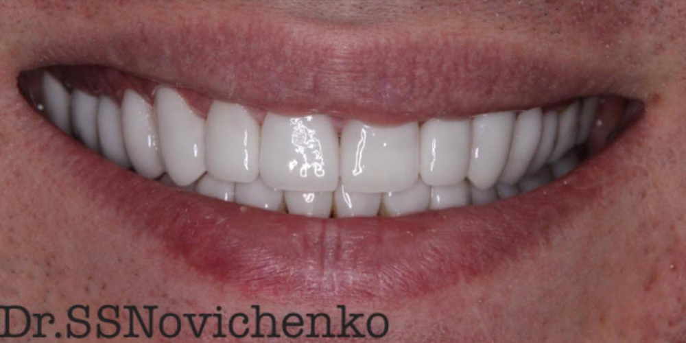  Реставрация стёртых зубов керамическими винирами