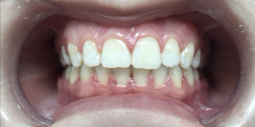  Исправление скрученности зубов на нижней челюсти