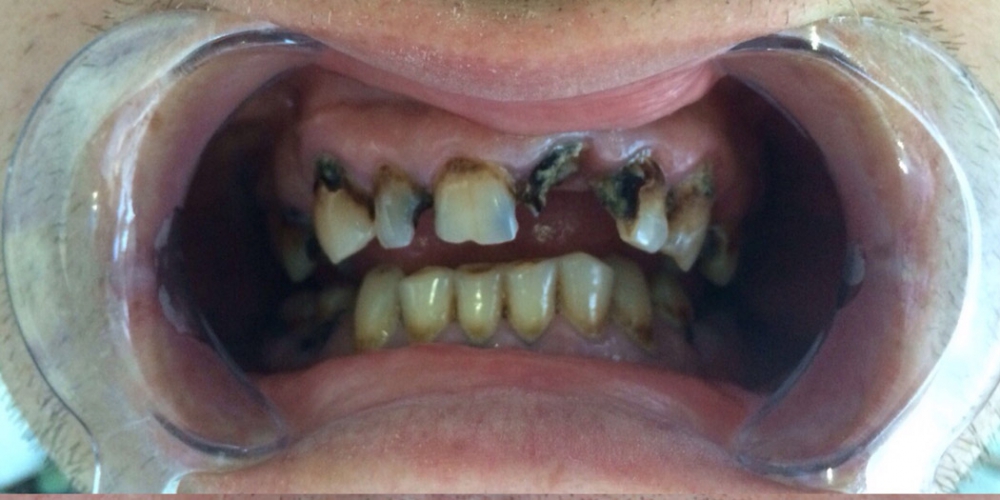  Восстановления жевательной и эстетической функции зубов