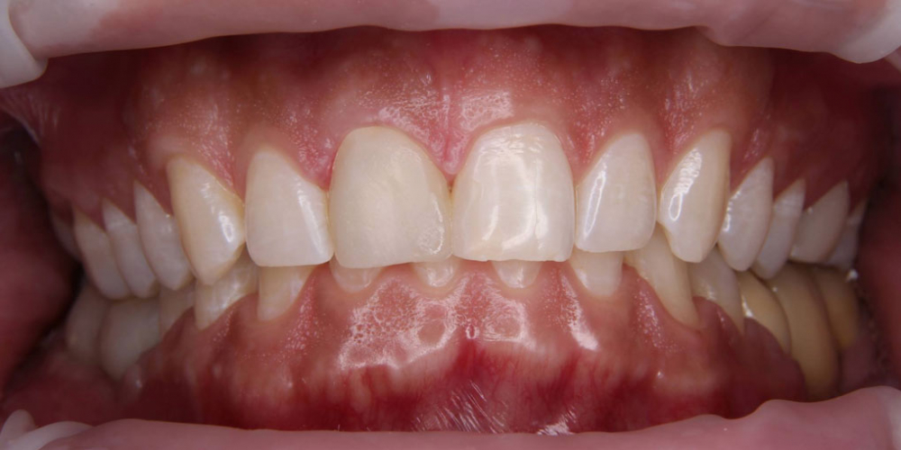  Керамическая коронка на передний зуб