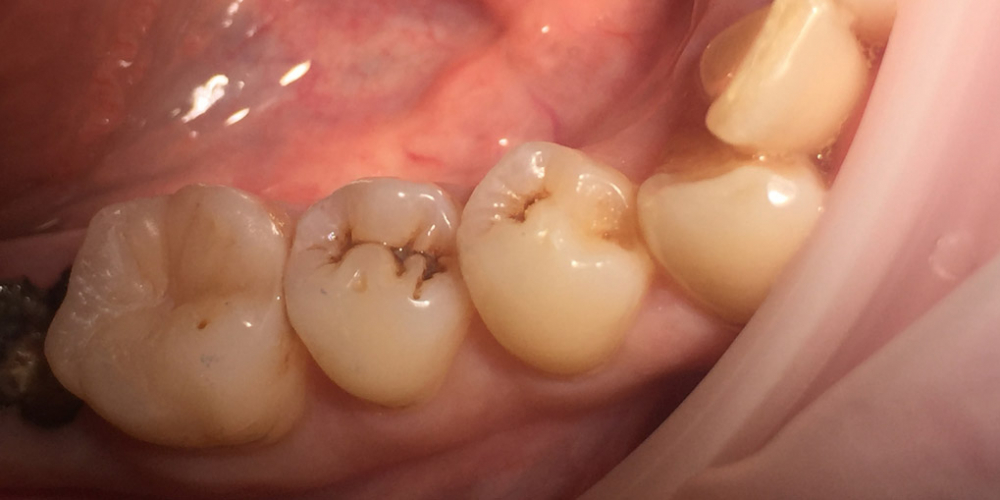  Восстановление зуба по 1 классу Блэка фотопломбой