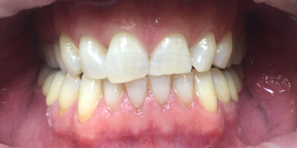  Офисное отбеливание зубов Системой Opalessens 