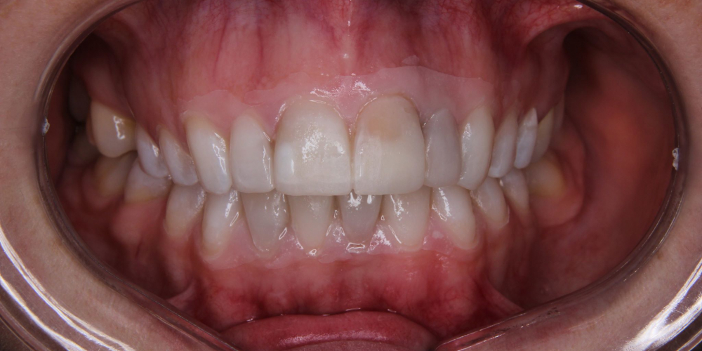  Исправление формы и цвета передних зубов при помощи виниров