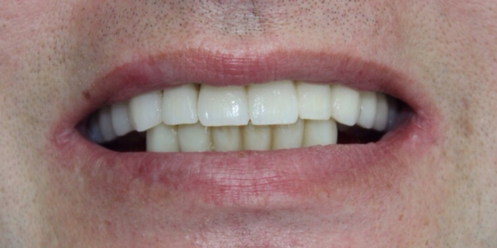  Восстановления жевательной и эстетической функции зубов