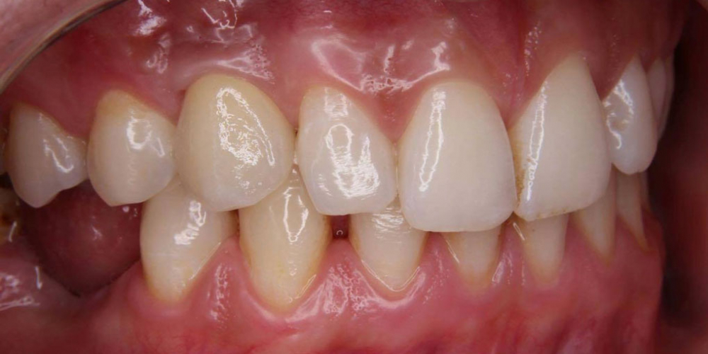  Восстановление утраченного зуба при помощи дентального импланта