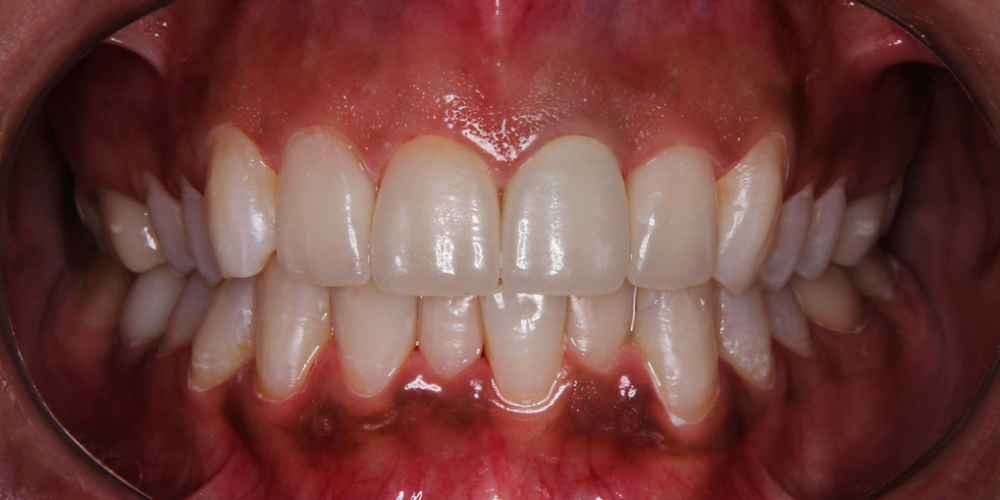  4 керамических винира + отбеливание зубов
