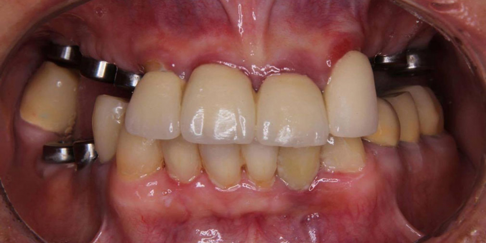  Операция комплексного восстановление зубов