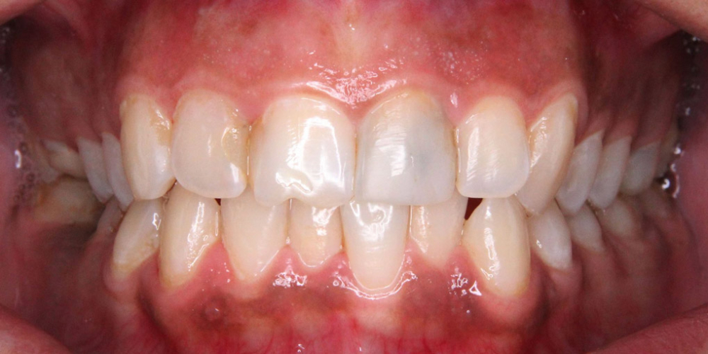  4 керамических винира + отбеливание зубов
