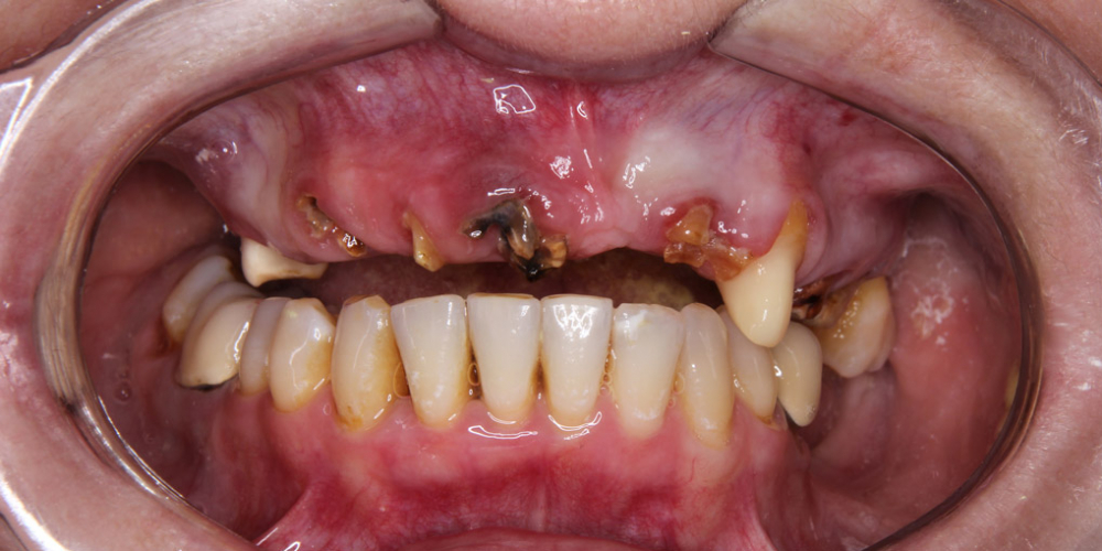 ФОто до лечения Жалобы на отсутствие зубов верхней челюсти