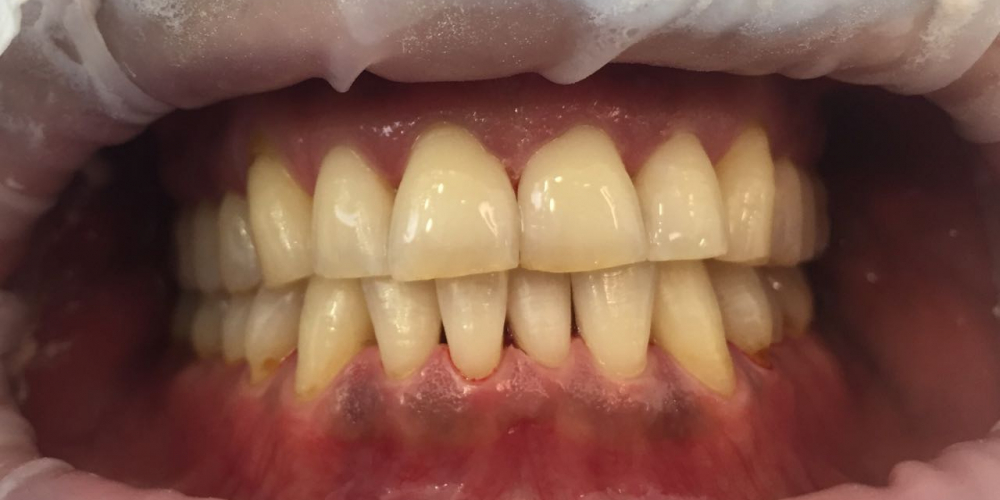  Жалобы на кровоточивость дёсен и зубные отложения