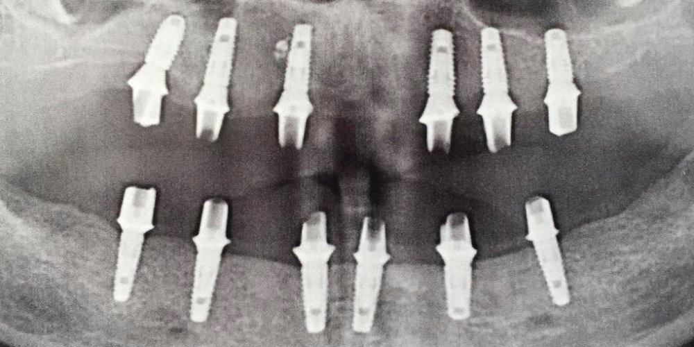  Протезирование металлокерамическими коронками на имплантатах при полном отсутствии зубов