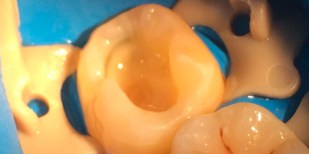  Лечение кариеса жевательного зуба