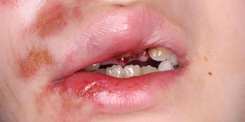 Реплантация передних зубов у ребенка фото до лечения