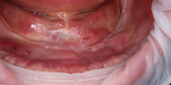 Телескопический бюгельный протез на нижнюю челюсть с опорой на имплантаты фото до лечения