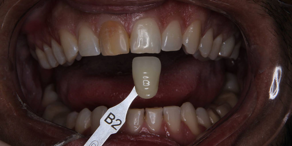  Керамическая коронка на передний зуб