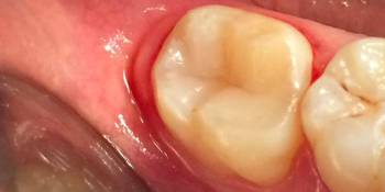 Лечение кариеса жевательного зуба фото после лечения