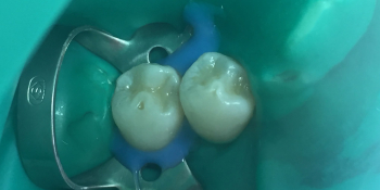 Восстановление зуба по 1 классу Блэка фотопломбой фото после лечения