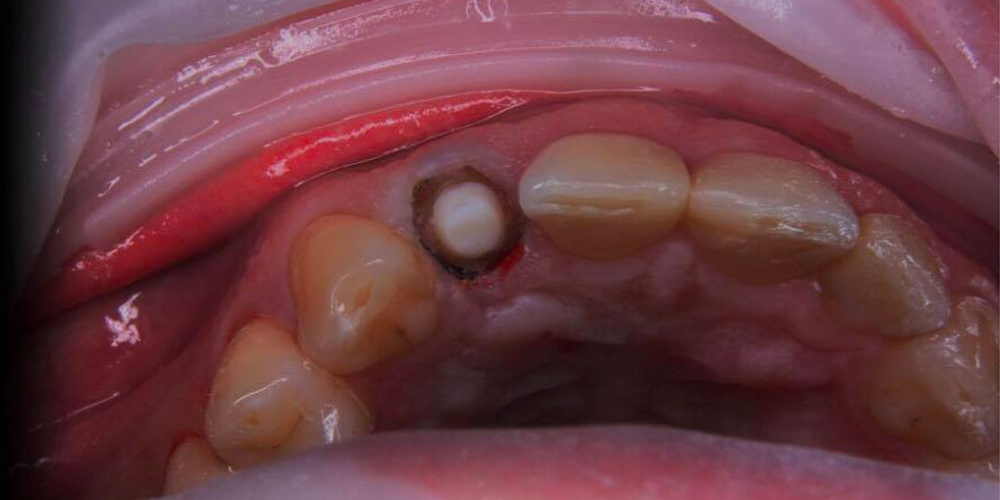 Спасение зуба и восстановление коронкой