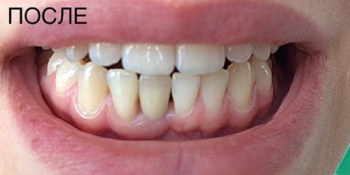 Восстановление переднего нижнего зуба имплантатом и коронкой фото после лечения