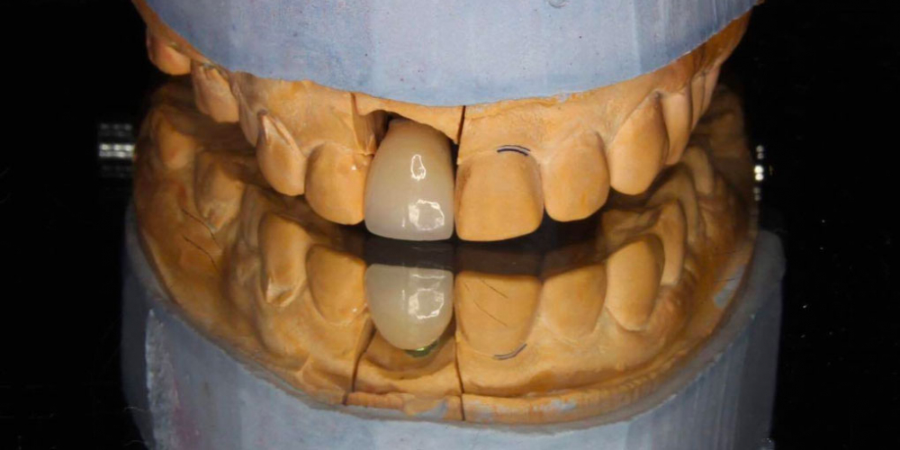  Результат имплантации зуба под ключ после перелома корня зуба