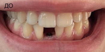 Восстановление переднего нижнего зуба имплантатом и коронкой фото до лечения