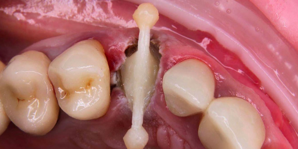  Пациент обратился с переломом коронки зуба