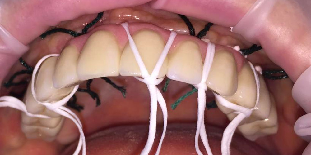  Протезирование металлокерамическими коронками на имплантатах при полном отсутствии зубов