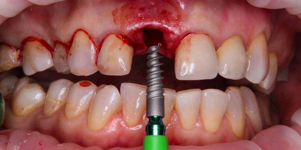  Результат имплантации зуба под ключ после перелома корня зуба