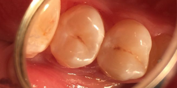 Кариес 14, 15 зубов фото после лечения