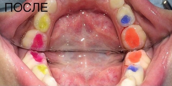 Лечение кариеса молочных зубов цветным композитом фото после лечения