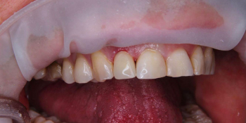 Спасение зуба и восстановление коронкой фото после лечения