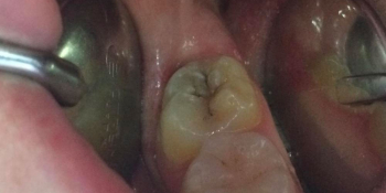 Лечение кариеса жевательного зуба фото до лечения