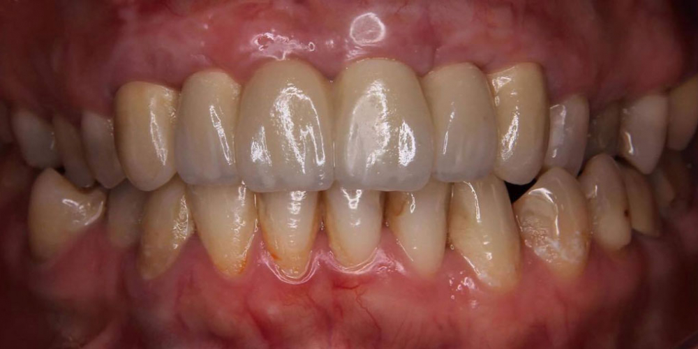 Восстановление передних зубов одномоментной имплантацией