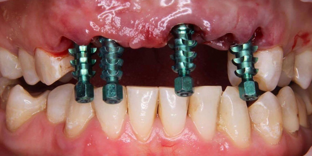  Восстановление передних зубов одномоментной имплантацией