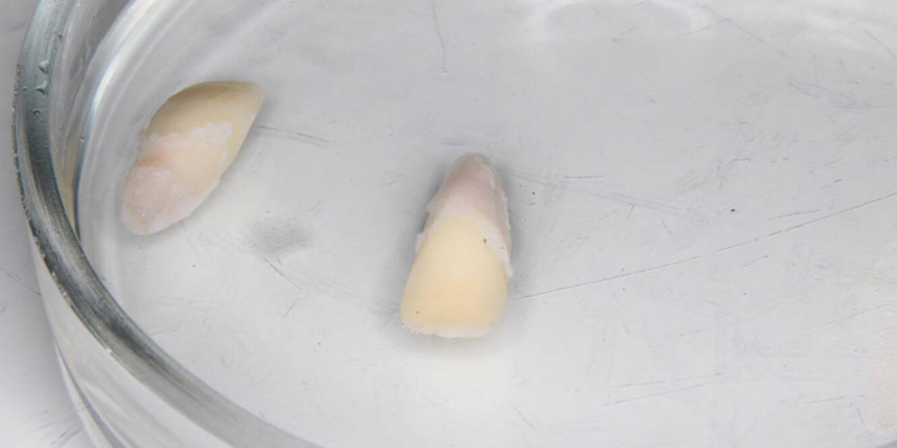  Реплантация передних зубов у ребенка