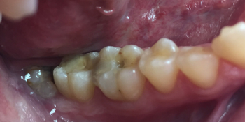 Реставрация жевательной группы зубов фото до лечения