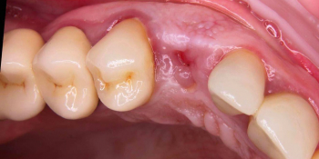Пациент обратился с переломом коронки зуба фото до лечения