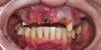 Жалобы на отсутствие зубов верхней челюсти фото до лечения