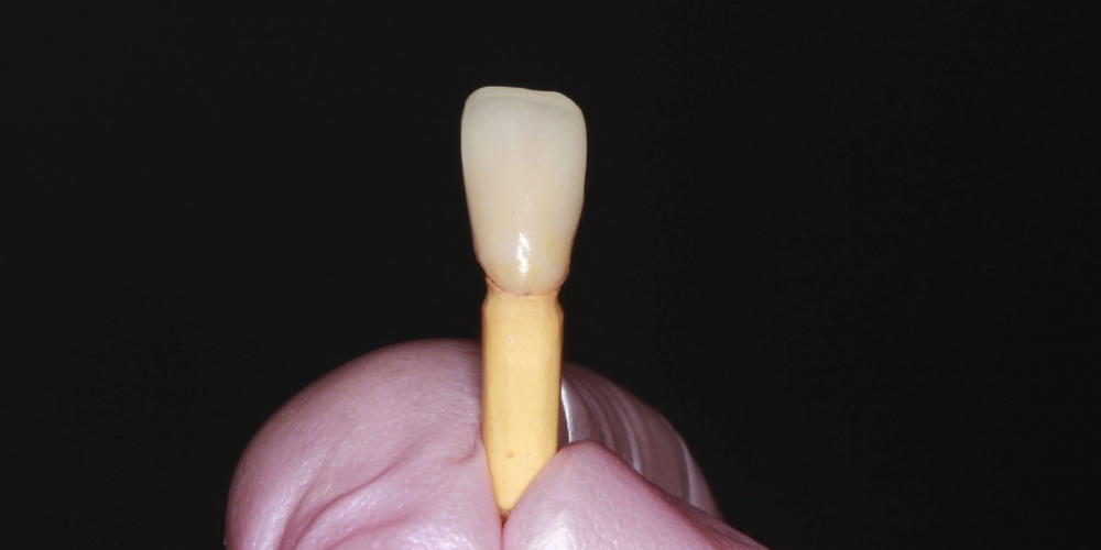  Пациентка обратилась с отломленным зубом ниже уровня десны