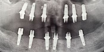 Протезирование металлокерамическими коронками на имплантатах при полном отсутствии зубов фото до лечения